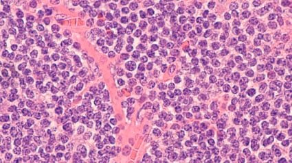 Fotomicrografia de um linfoma de células do manto 
