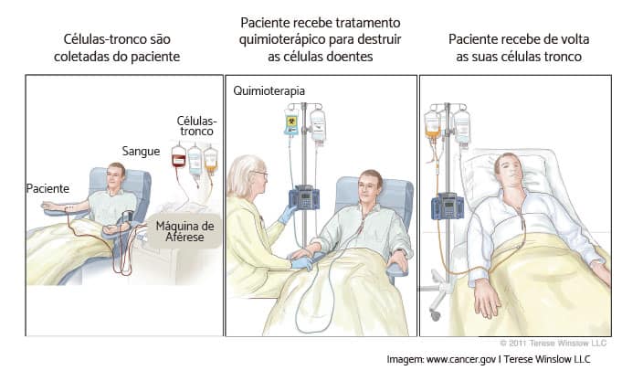 transplante de medula óssea