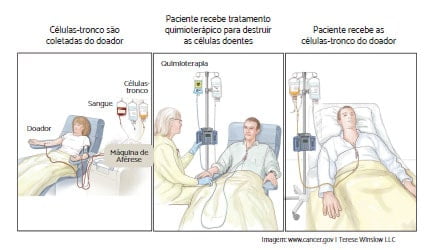 Transplante_de_medula_ossea_alogenico_LMMC