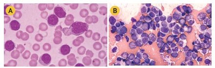 Celulas_de_Leucemia_Linfoide_Aguda